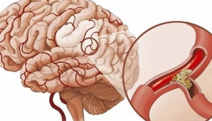 Beyin qan damarlarının tıxanması - Əlamətlər