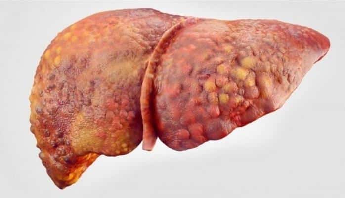 Sirrozu təkcə hepatit yaratmır, başqa səbəblər də çoxdur