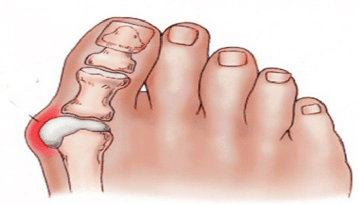 "Выступающая косточка" на стопе: 5 способов от нее избавиться