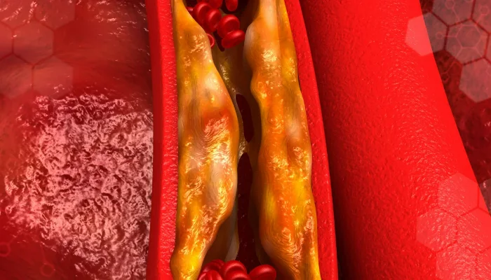 İnsan arteriyalarının bütün nümunələrində mikroplastik hissəciklər aşkar edilib