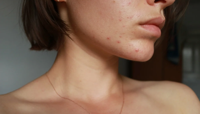 Yayda qadağan olunan kosmetik prosedurlar - Rusiyalı həkimdən vacib xəbərdarlıq